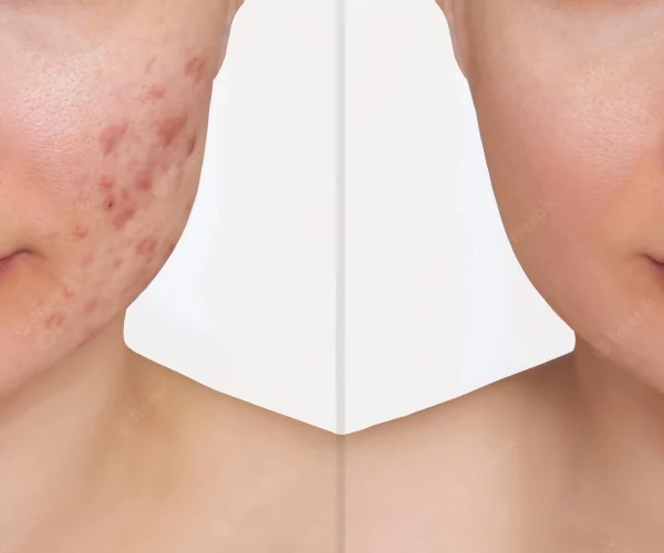 Advice For Acne Free Skin